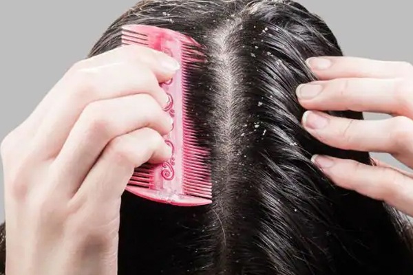 hair-loss and dandruff shampoo Purchase Price + Sales In Trade And Export