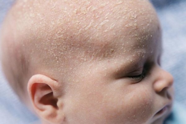 Introduction of Shampoos for Cradle Cap + Best buy price