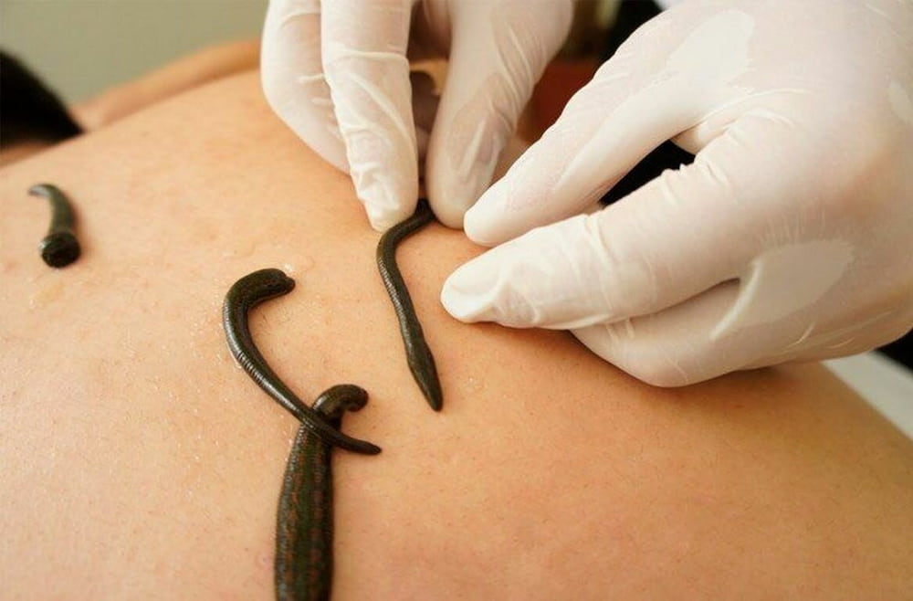 Benefits of leech therapy for cosmetic purposes