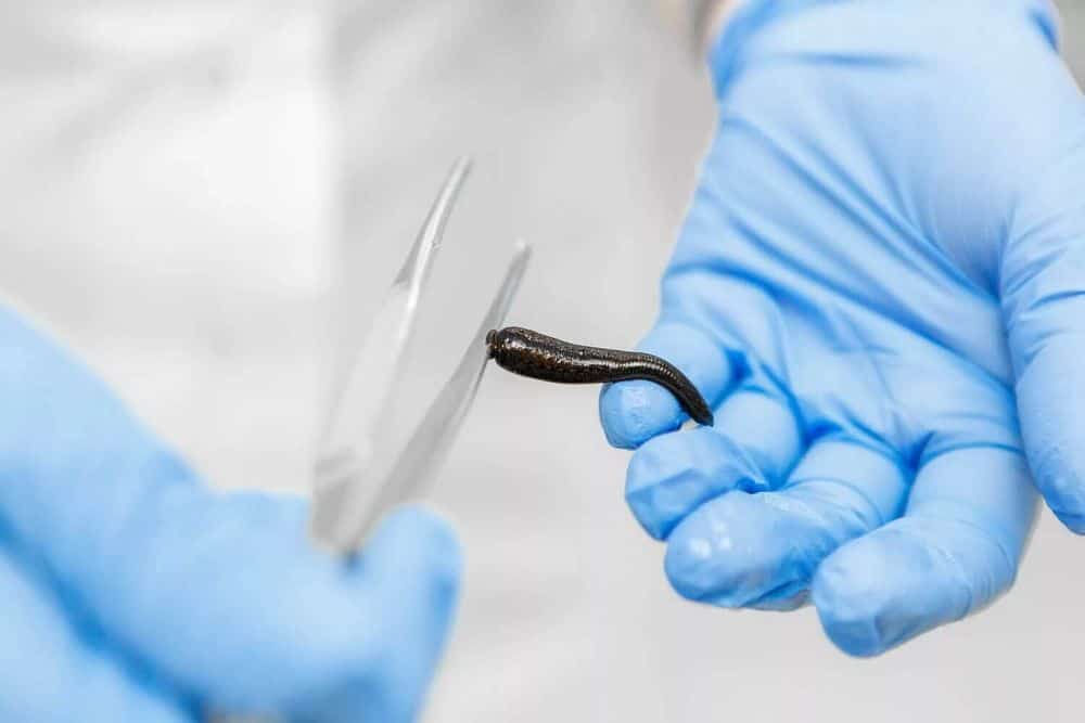 Leech therapy for flap congestion