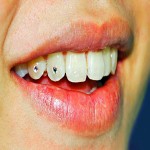 نگین دندان مدل چسبی + قیمت خرید ( از کجا بخریم)