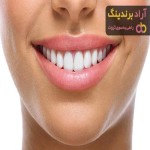 مشخصات لمینت متحرک دندان + قیمت خرید