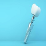 ایمپلنت دندان شماره 1 (پروتز ثابت) سوئیسی آلمانی طبیعی جنس تیتانیوم