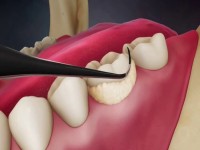 سیکل اسکیلر دندانپزشکی؛ بسته بندی آلیاژ مستحکم جرم گیری دندان Scaler