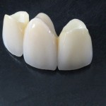 روکش پلاستیکی دندان؛ زیبا سازی بی ضرر  تحت نظارت مهندسین پزشکی Plastic