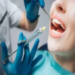 خرید عمده سرنگ تزریق دندانپزشکی بدون درد با بهترین شرایط