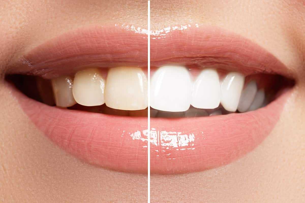 مشخصات سفید کننده دندان بلیچینگ