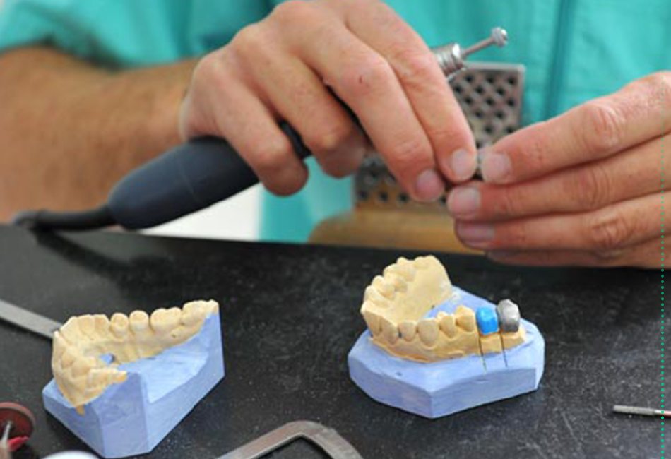 گپ قالب گیری دندان سازی